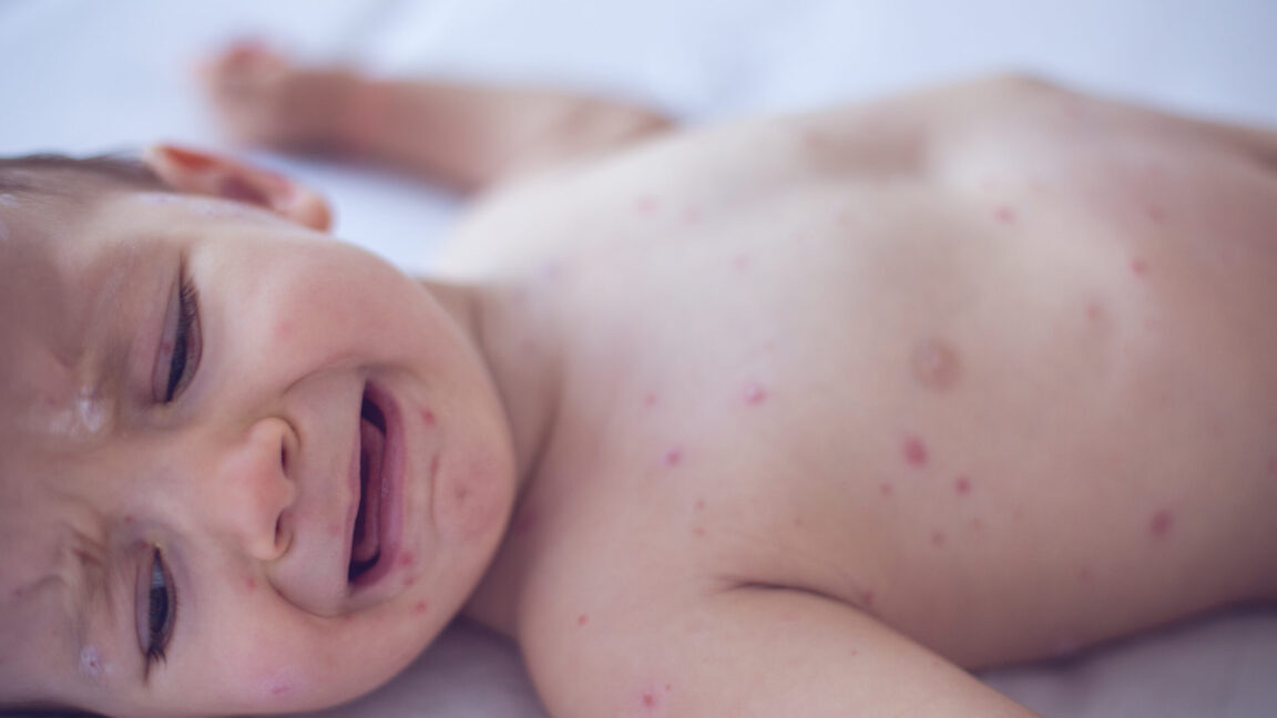 Pennsylvania Issues Alert on Dangerous Congenital Measles Amid Rising Cases